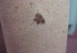 Melanoma images