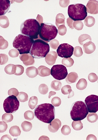 Leucemia linfoide aguda images