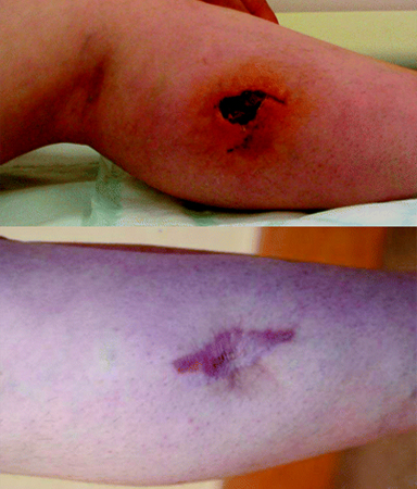 treating dog bite wounds