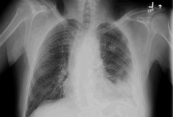 Pleural effusion images