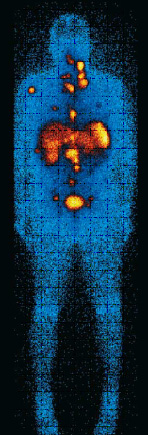 Síndrome carcinoide images