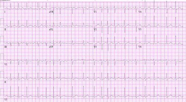 New-onset atrial fibrillation images