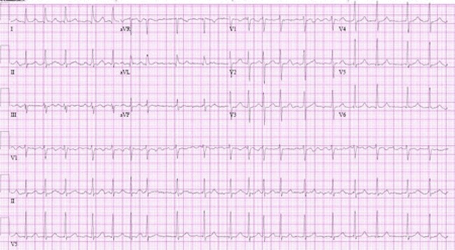Fibrilación auricular de inicio reciente images
