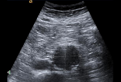 Ultrasound of a 3.8 cm x 4.2 cm AAA