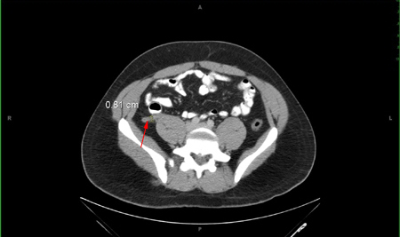 CT abdomen - thickened appendix