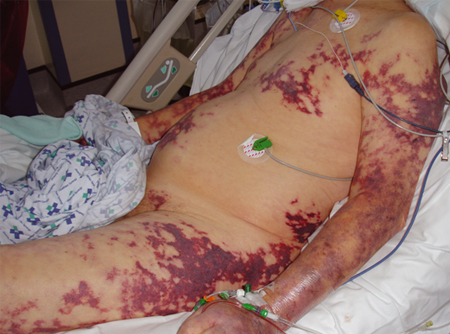 Severe purpura fulminans; classically associated with meningococcal sepsis but can occur with pneumococcal sepsis