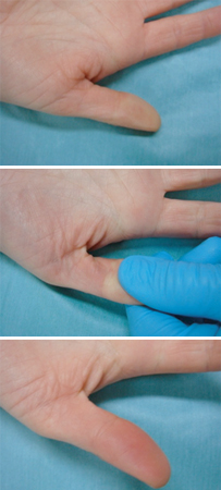 Sepse em adultos images