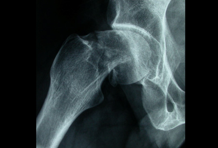Hip fracture images