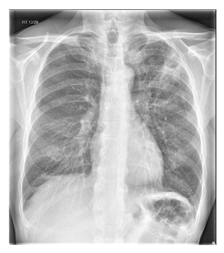 Radiografia de tórax mostrando pneumonia cavitando no lobo superior esquerdo