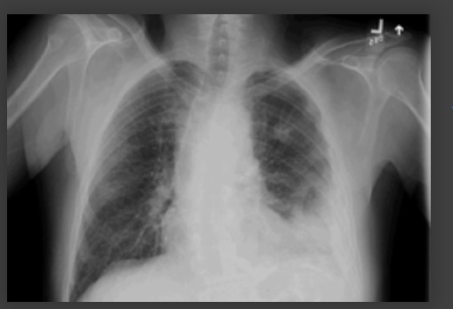 Derrame pleural no lado esquerdo