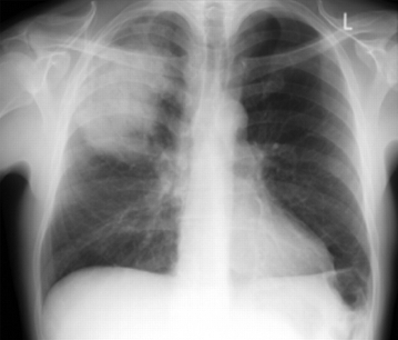 后前位胸部 X 线片显示社区获得性肺炎患者右上肺叶实变