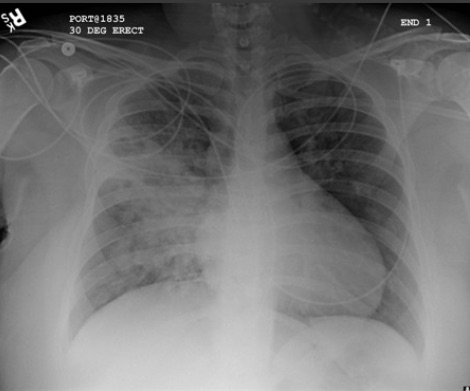 右肺门区域，右肺上叶与下叶上段阴影增加与吸入性肺炎加重相一致