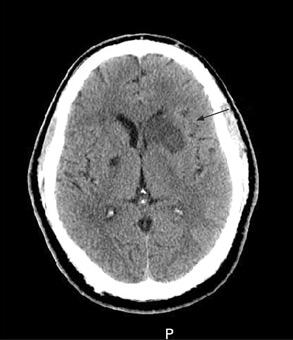 Accidente cerebrovascular isquémico images