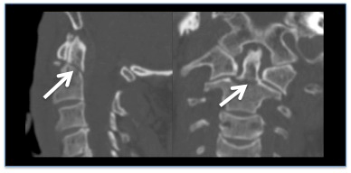 Trauma agudo da coluna cervical em adultos images
