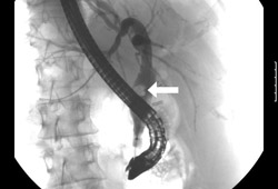 Acute cholangitis images