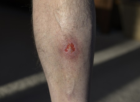 Celulitis y erisipelas images