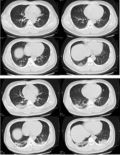 Transverse CT scans from a 32-year-old man, showing ground-glass opacity and consolidation of lower lobe of right lung near the pleura on day 1 after symptom onset (top panel), and bilateral ground-glass opacity and consolidation on day 7 after symptom onset