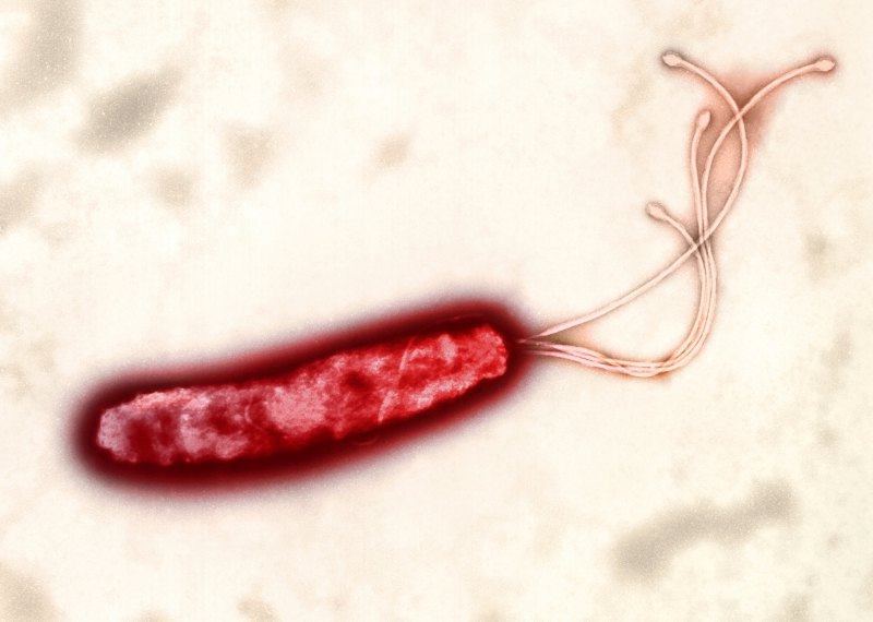 Enfermedad ulcerosa péptica images