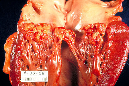 Gross pathology of subacute bacterial endocarditis involving mitral valve