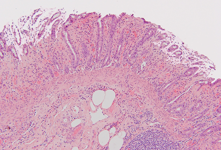 Histopathology of intestinal ischaemia