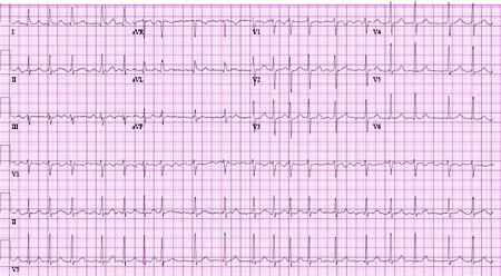 Atrial fibrillation