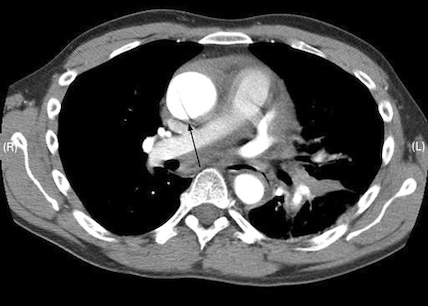 Aortic dissection images