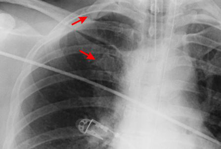 Rib Fractures - Symptoms, Diagnosis And Treatment | BMJ Best Practice