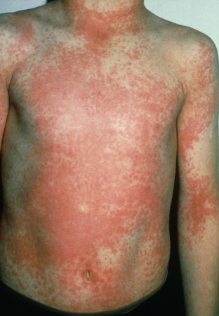 Scarlet fever images