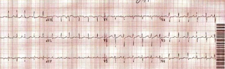 Postural orthostatic tachycardia syndrome images
