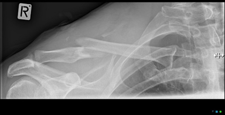 Clavicle fracture images
