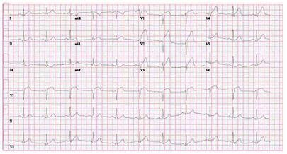 Brugada syndrome images