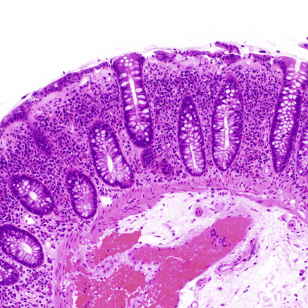 Microscopic colitis - Symptoms, diagnosis and treatment | BMJ Best Practice