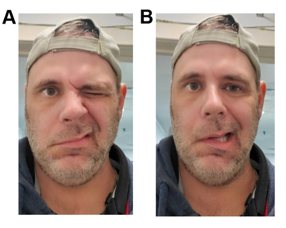 Ramsay Hunt syndrome images