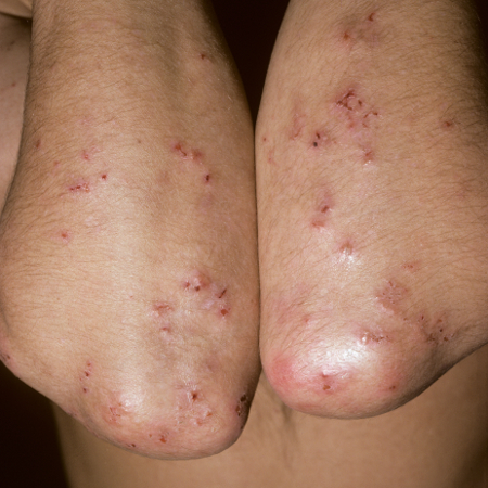 Dermatitis herpetiformis images