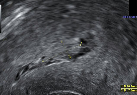 Postpartum haemorrhage images