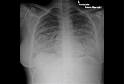 Acute heart failure images