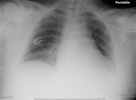 Hospital-acquired pneumonia (non COVID-19) images