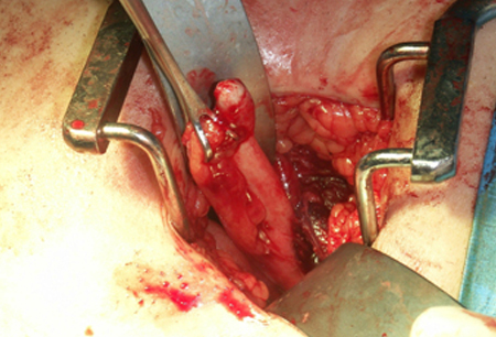 Acute appendicitis - intraoperative specimen.