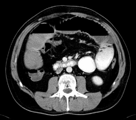 Ileus images