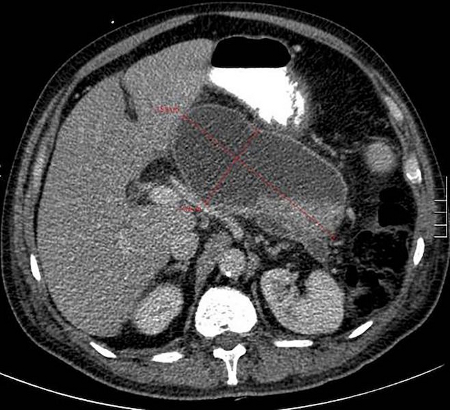 Acute pancreatitis images