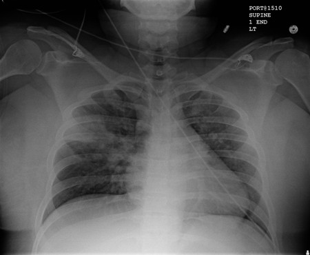 Aspiration pneumonia images