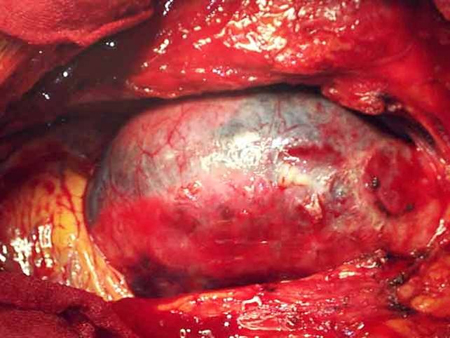 Aortic dissection images