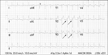 Pericarditis images