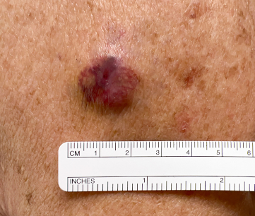 Merkel cell carcinoma images