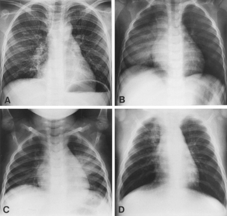 Community-acquired pneumonia in children images