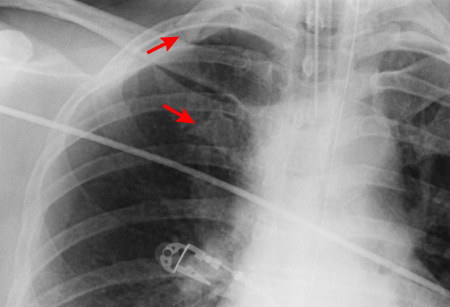 Rib fractures images