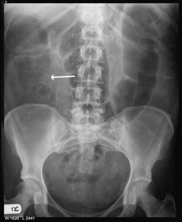 Large bowel obstruction images