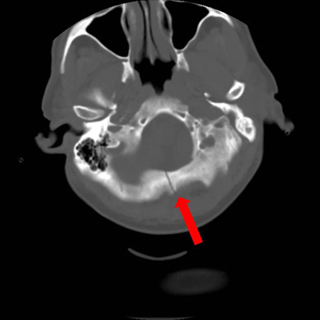 Axial CT scan showing nondepressed linear skull fracture (arrow) of the skull base involving the foramen magnum. This injury pattern is concerning for associated spinal fracture, cord injury, and blunt cerebrovascular injury