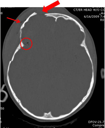 Axial CT scan demonstrating open elevated linear skull fracture (large arrow). Note the air in the soft tissues (small arrow), the small amount of pneumocephalus associated with the fracture (circle), and that the level of elevation of the bone fragment is significantly more than the thickness of the bony table