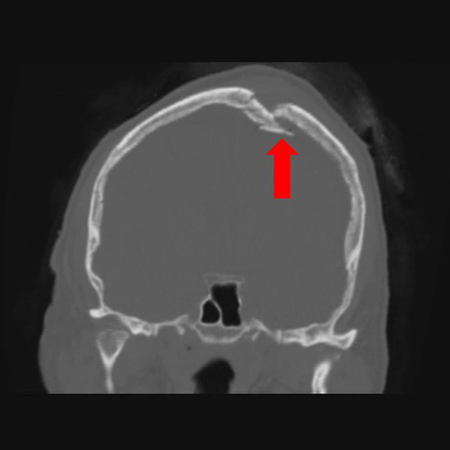 Coronal CT of an open, comminuted, depressed skull fracture. The level of depression is greater than the bony table and there are several bone fragments impacted below the inner cortex of the opposing bone (large arrow). Despite lack of underlying associated brain injury this fracture required operative debridement and elevation of the bone fragments. See also the corresponding sagittal CT image